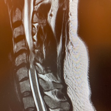 Röntgenfoto van een nekhernia. Ter illustratie dat succesvol functioneren niet hetzelfde is als floreren.